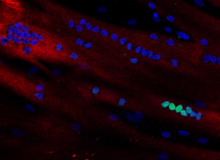 Gentherapie inzetten om de productie van het eiwit DUX4 te stoppen bij FSHD