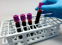 Uitkomstmaten voor kinderen met myotone dystrofie (ANIQc-MD)