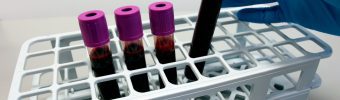 Uitkomstmaten voor kinderen met myotone dystrofie (ANIQc-MD)
